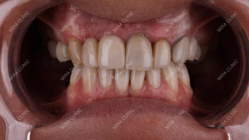 6 Dental Implants